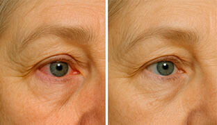Before and after using TheyaVue