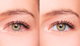 Bright, healthy eyes after TheyaVue