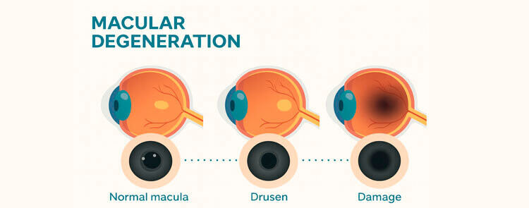 Macular degeneration progression